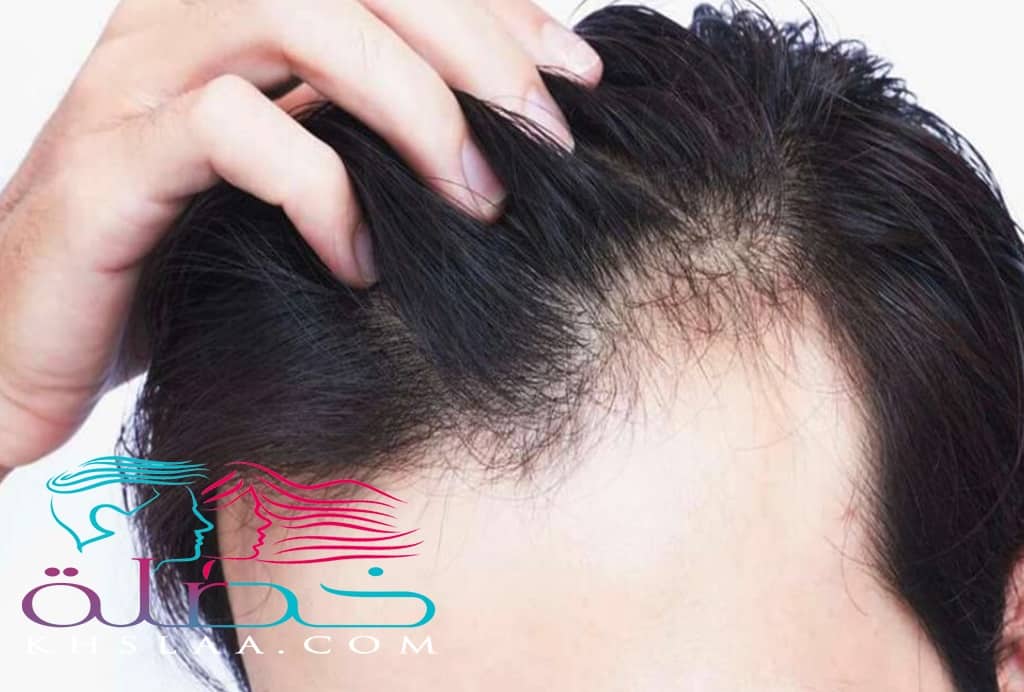 حماية الشعر من التساقط للرجال أسباب تساقط الشعر وطرق الوقاية منه خصلة